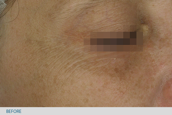 Foto particolare delle rughe vicino all'occhio prima l'uso della maschera