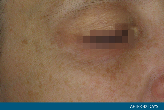 Foto particolare delle rughe vicino all'occhio dopo l'uso della maschera