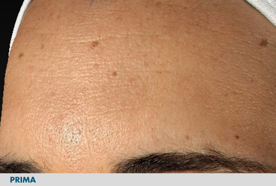 Foto particolare delle rughe vicino all'occhio prima