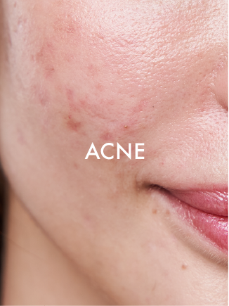 ACNE