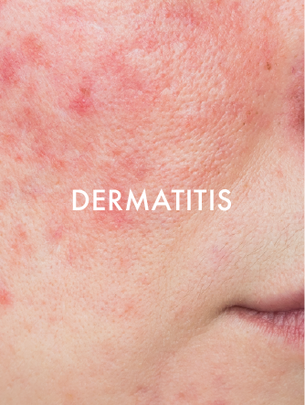 DERMATITIS