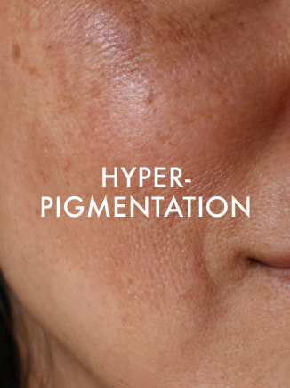 HYPER PIGMENTATION