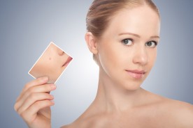 L'acne: un processo che si può sconfiggere con rimedi efficaci