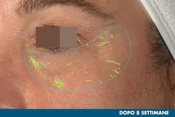 Foto particolare delle rughe vicino all'occhio dopo l'uso della maschera
