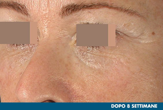 Foto particolare delle rughe vicino all'occhio dopo l'uso della maschera
